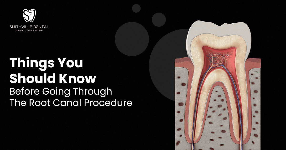Things You Should Know Before Going Through The Root Canal Procedure
