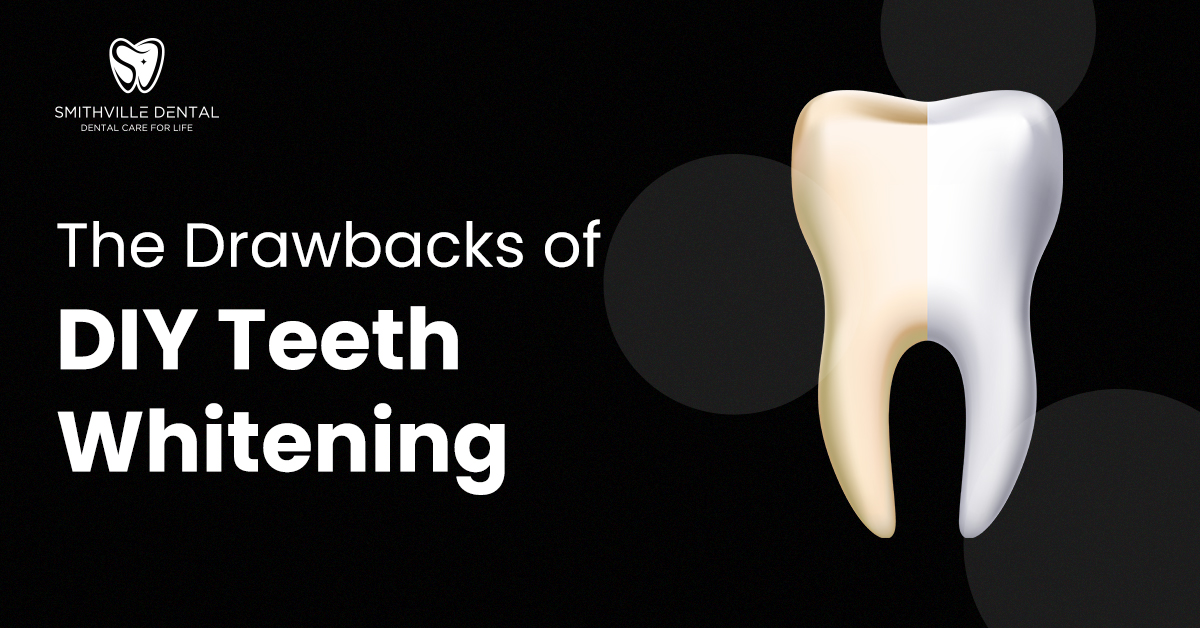 The Drawbacks of DIY Teeth Whitening