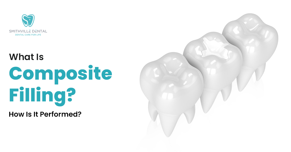 What is Composite Filling? How is it performed?