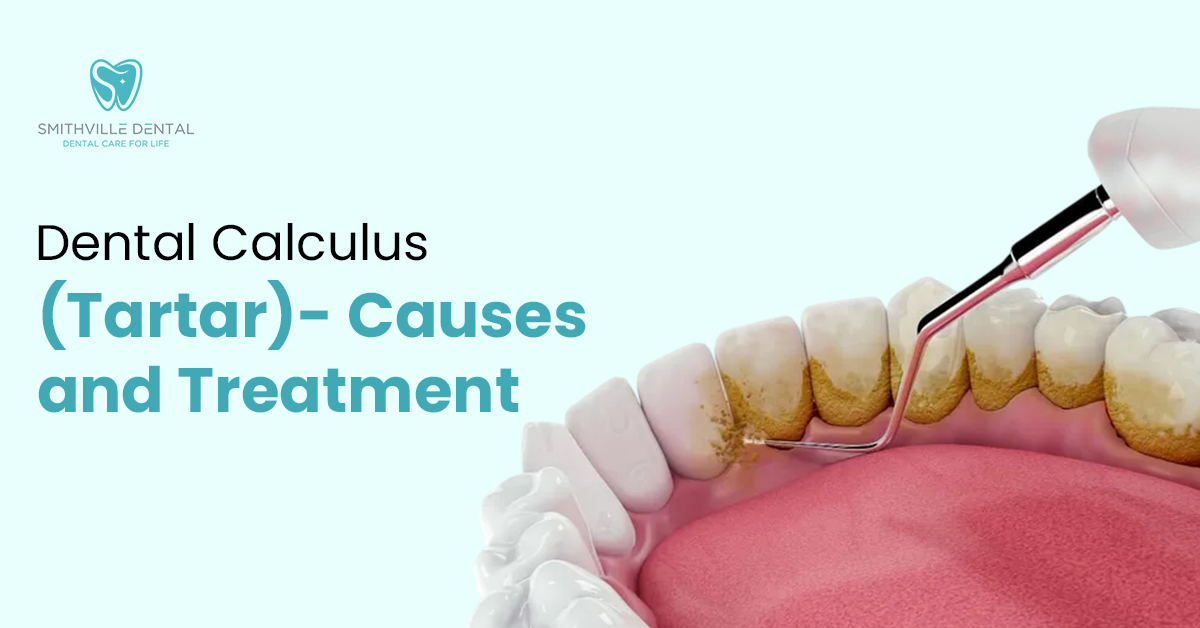 Dental Calculus (Tartar)- Causes and Treatment