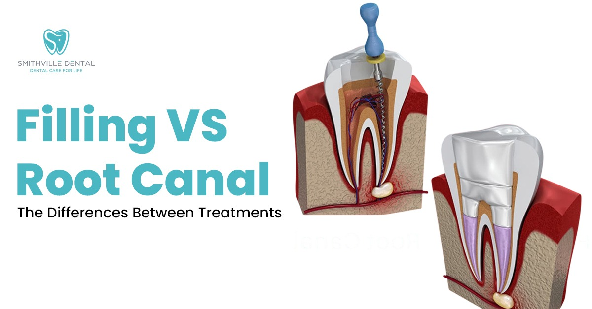 Filling VS Root Canal – The Differences Between Treatments