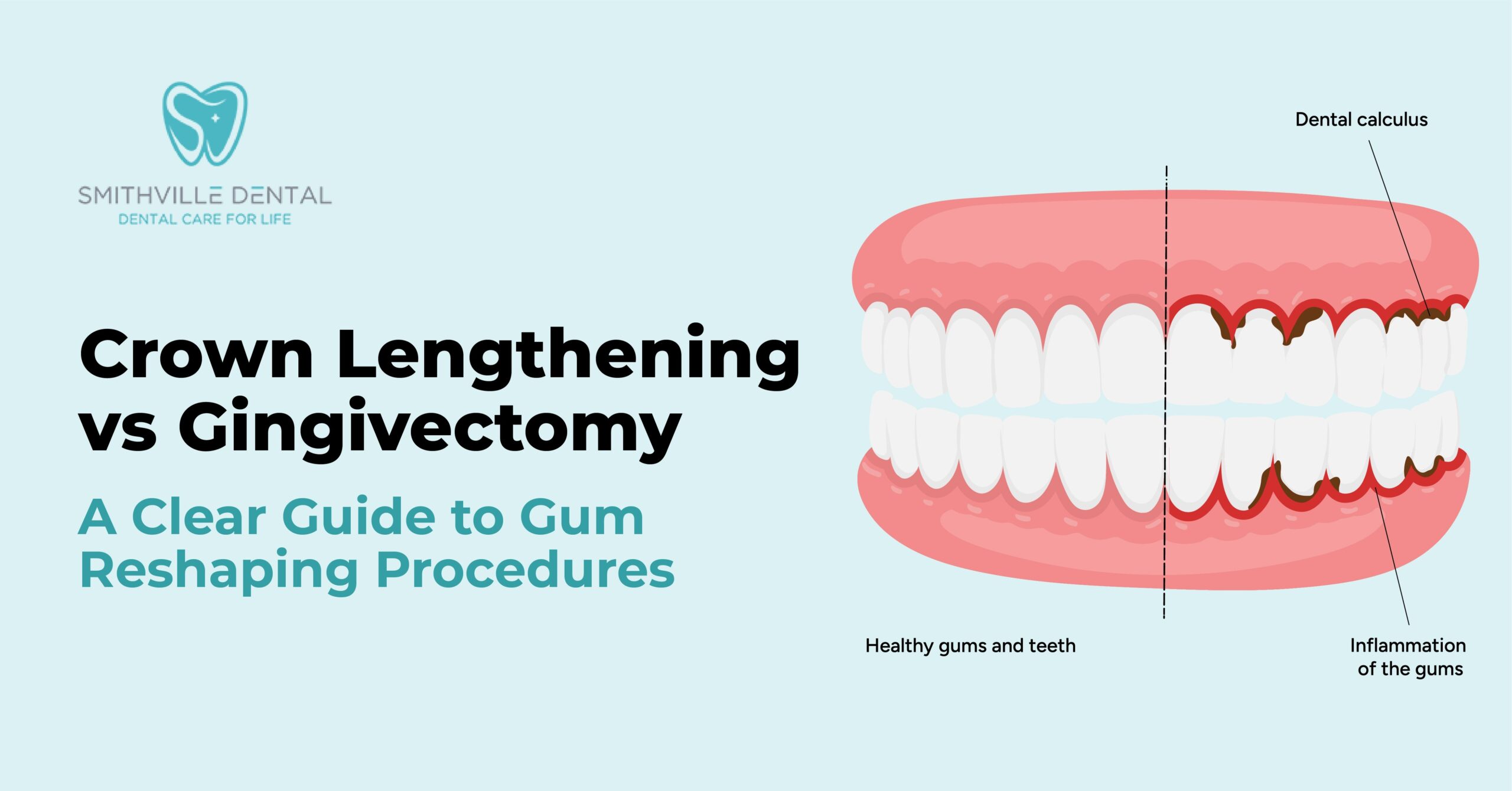 Crown Lengthening vs Gingivectomy: A Clear Guide to Gum Reshaping Procedures