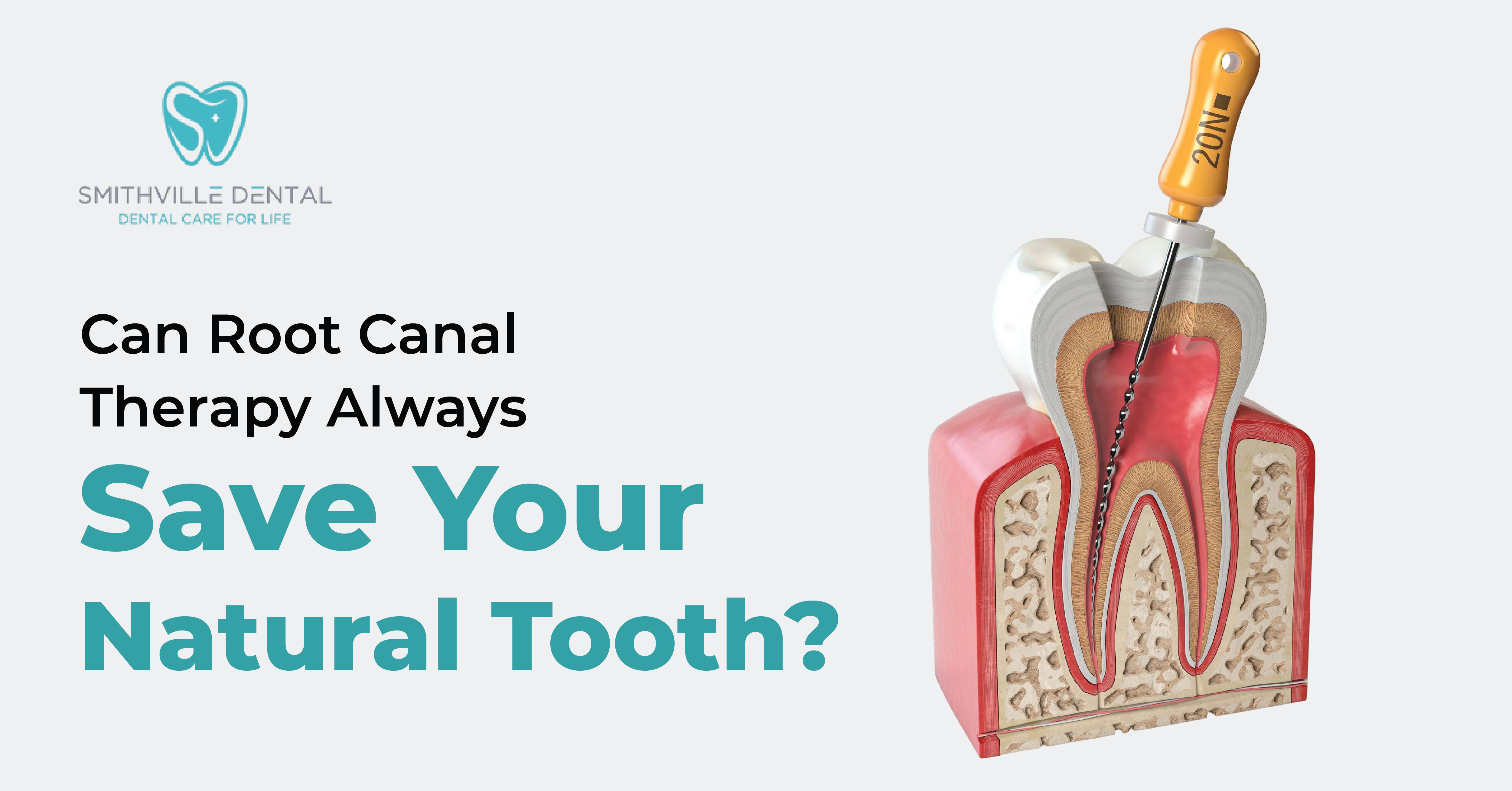 Can Root Canal Therapy Always Save Your Natural Tooth?