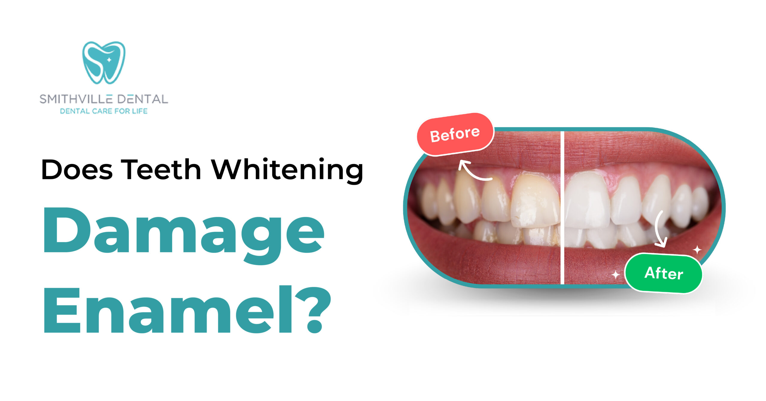 Does Teeth Whitening Damage Enamel?