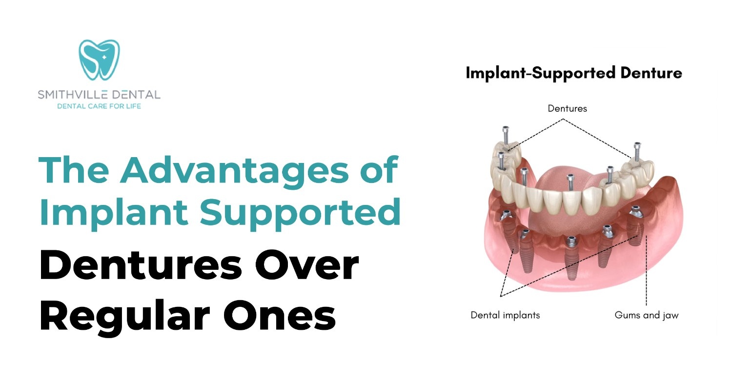 The Advantages of Implant-Supported Dentures Over Regular Ones